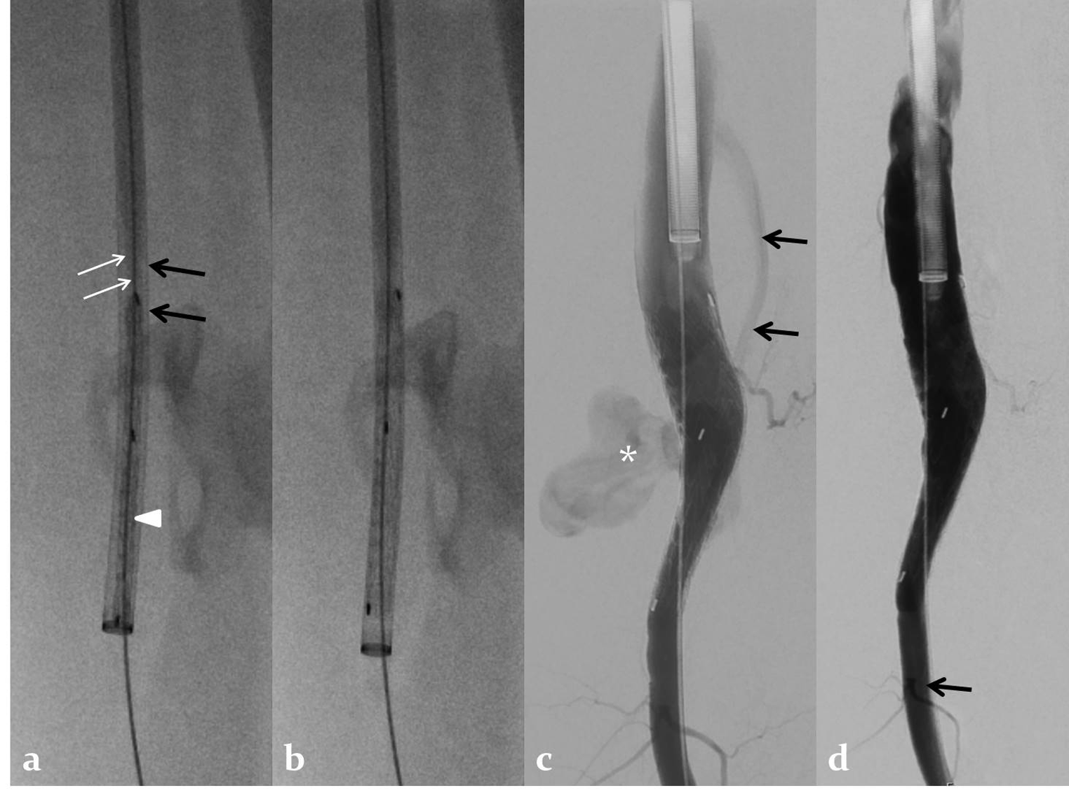 A 60-year-old man with post-traumatic chronic femoral pseudoaneurysm with arteriovenous fistula. (a) Fluoroscopic image shows reversed Gore Excluder stent-graft (arrow head) pushed to the site of the fistula within the sheath (black arrows) by a cut-end dilator (white arrows). (b) Fluoroscopic image shows released Gore Excluder stent graft within the sheath. (c) Digital subtraction angiogram after deployment of the stent-graft at the site of the fistula shows a small contrast leak into the pseudoaneurysm (asterisk) and draining vein (arrows). (d) Post-procedure angiogram after modeling the stent-graft with a compliant balloon shows no residual leak, patent stent graft, and good flow to the femoral artery distal to the fistula (arrow).