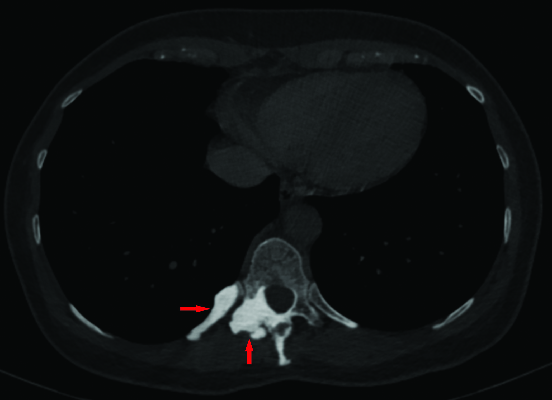Axial CT image at a lower position compared to Figure 1A, also in bone windows, shows dense sclerotic changes also involving the adjacent T10 rib.