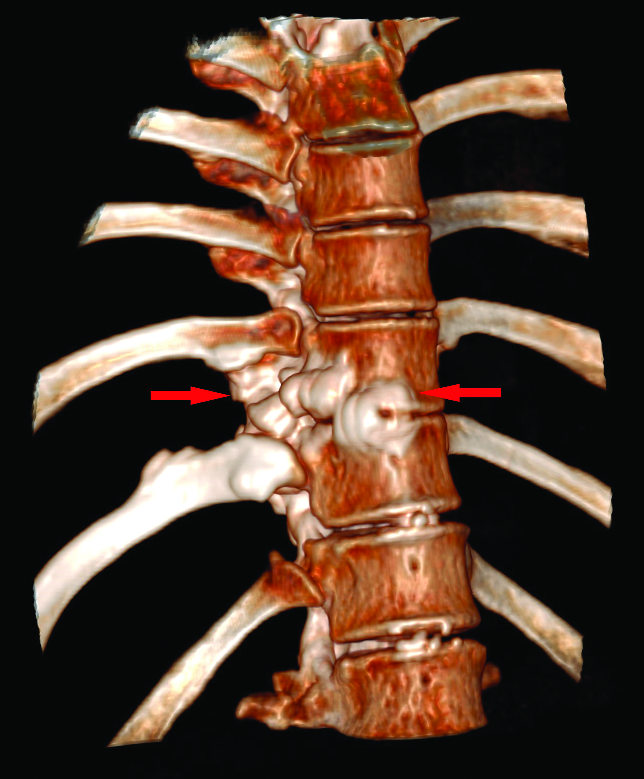 Volume rendered CT image of the lower thoracic spine, shows the bony expansion of the vertebral bodies and ‘dripping candle wax’ appearance of the vertebra.