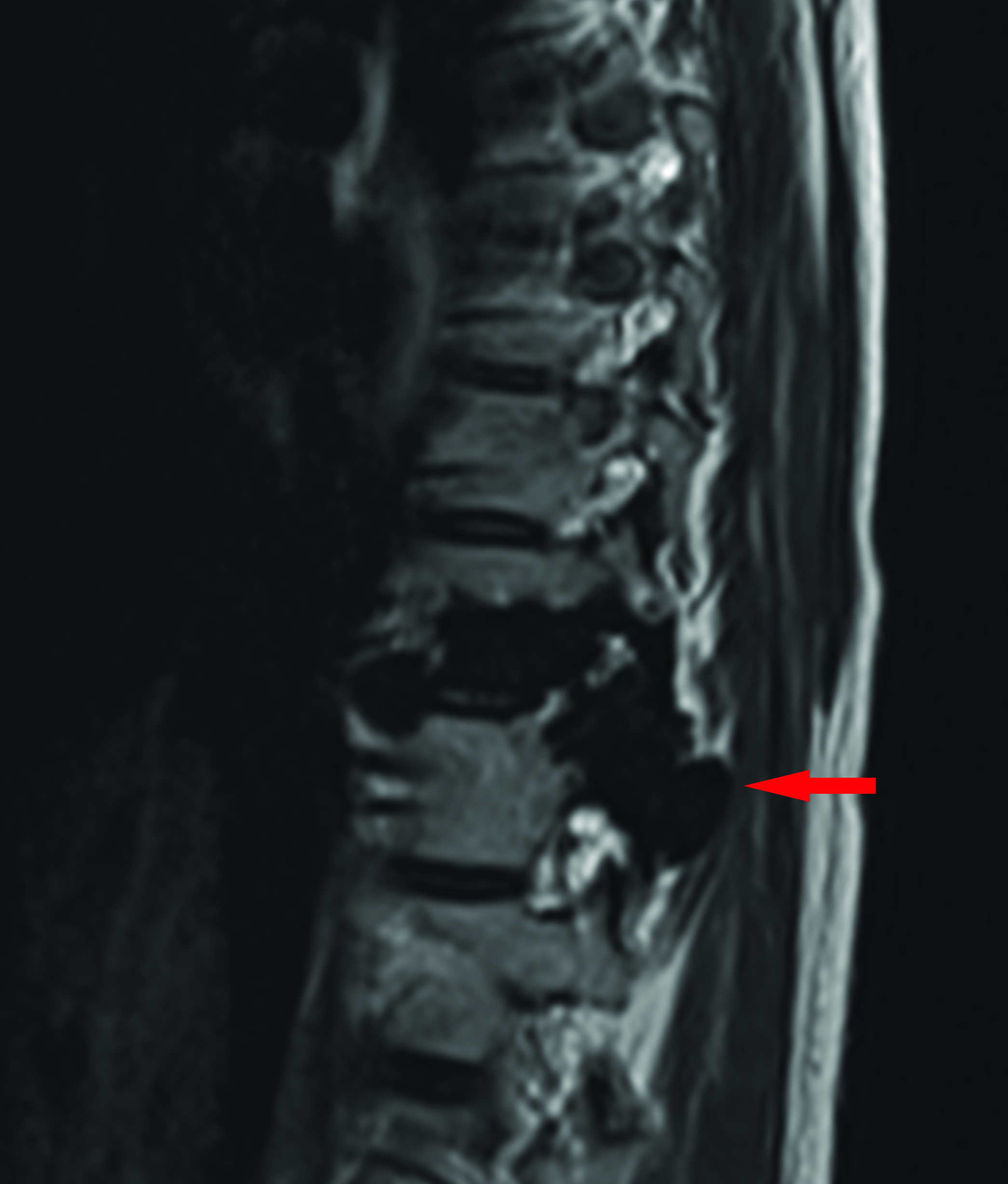 Sagittal T2 weighted images of the lower thoracic spine, demonstrating low signal change in the spine on both sequences, Figure 1E and 1F, consistent with a dense osteosclerotic bone lesion. There is involvement of the posterior elements and evidence of mild expansion.