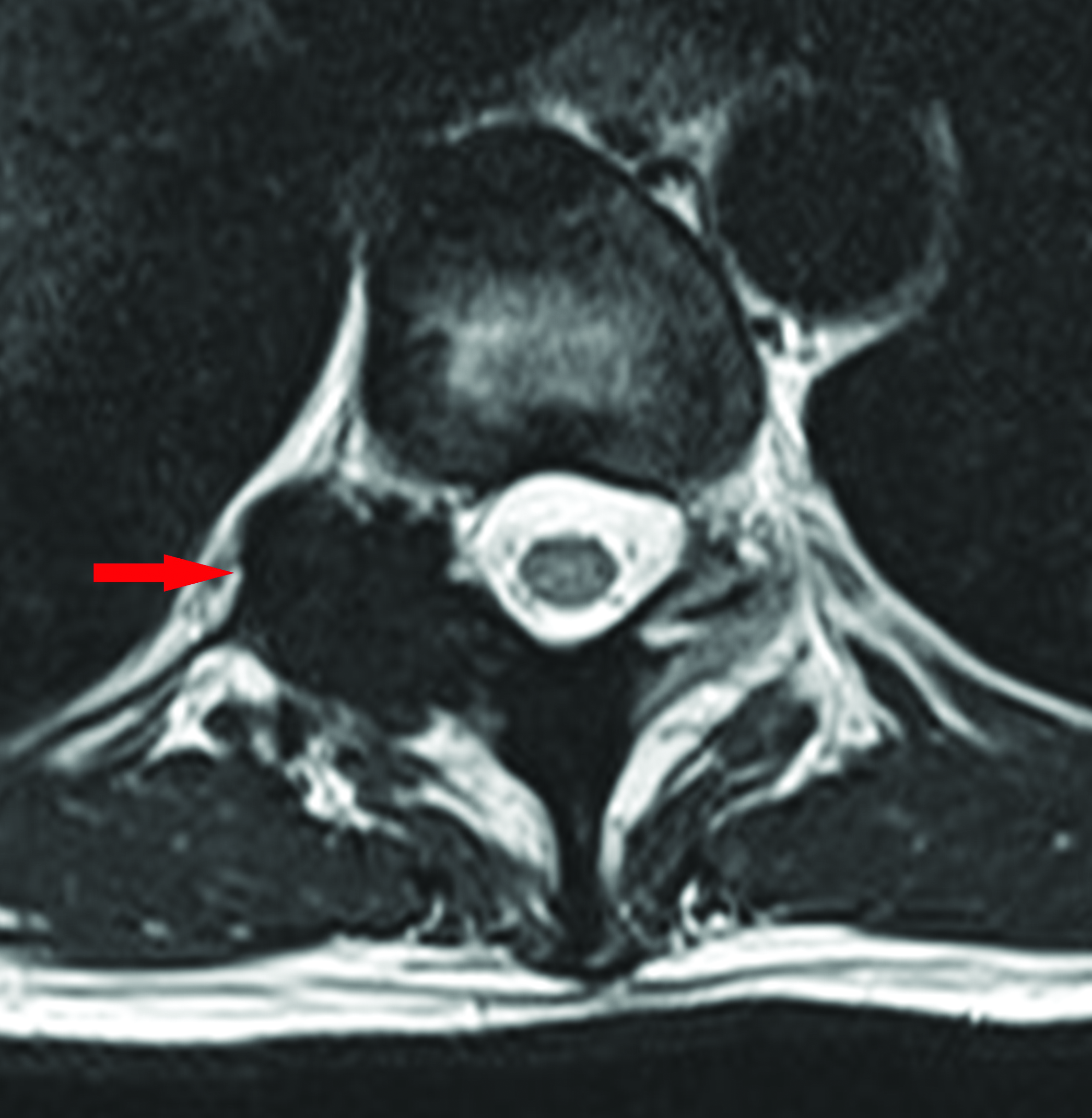 Axial T2 weighted image at the level of the T10-11 disc, shows loss of signal in the right posterior elements of T11 with bony expansion and narrowing of the right neural exit foramen.