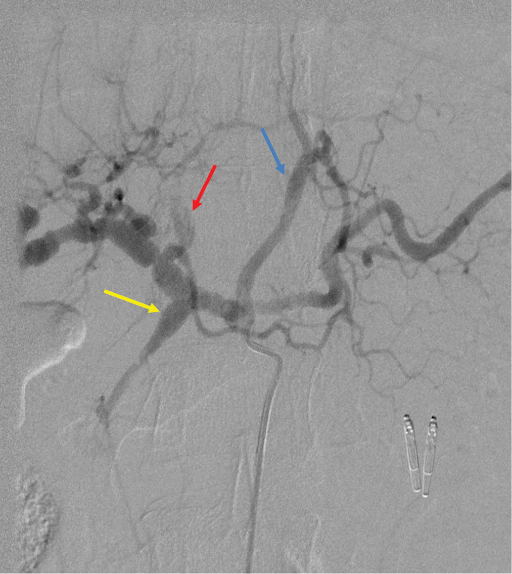 Digital subtraction angiography of celiac trunk showing fusiform dilation of the gastroduodenal (yellow arrow) and left gastric (blue arrow) arteries. The left hepatic artery pseudoaneurysm can also be seen (red arrow).
