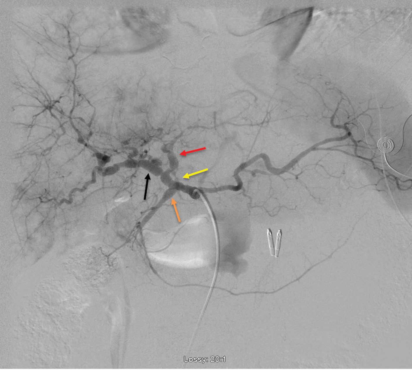 Digital substraction angiography of celiac trunk demonstarting diffuse sequential beaded aneurysmal dilations of common hepatic and proper hepatic (yellow arrow) arteries extending into the proximal left (red arrow) and right hepatic (black arrow) arteries. Also, fusiform dilation of the gastroduodenal artery (orange arrow) can be seen.