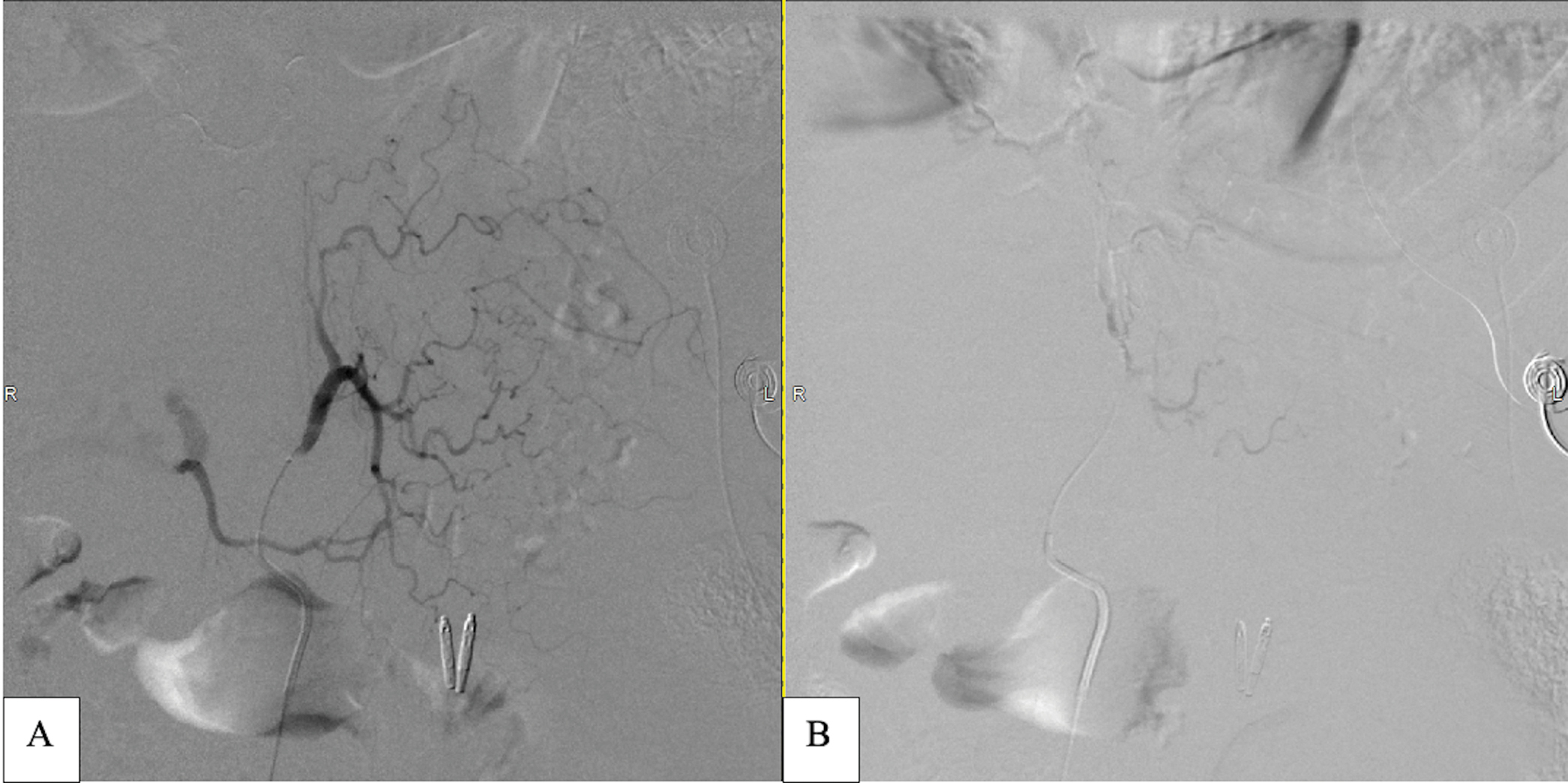 Digital subtraction angiography of pre and post embolization images of the LGA. (a) LGA showing no active extravasation. (b) Post Gelfoam slurry prophylactic embolization of the LGA showing complete stasis.