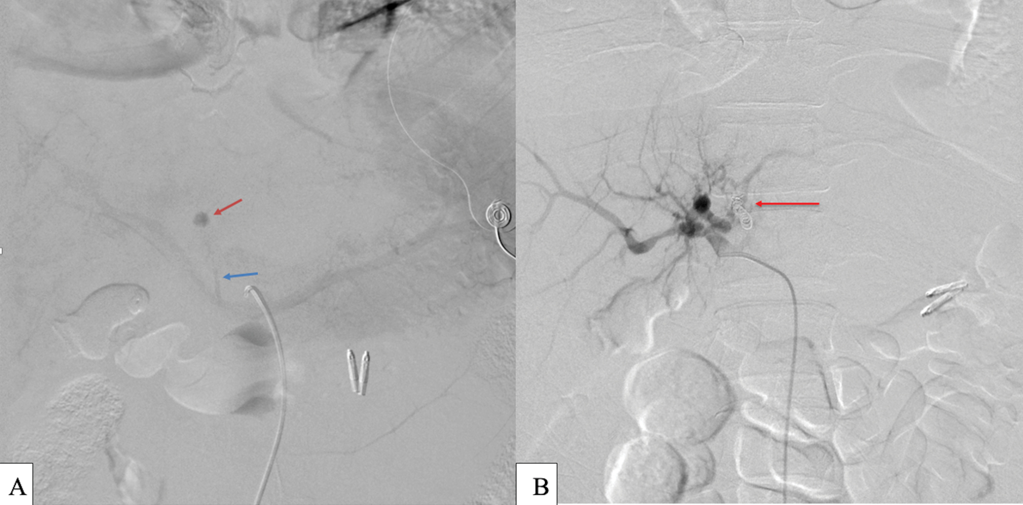 Digital subtraction angiography of the proper hepatic artery: (a) Left hepatic artery round pseudoaneurysm (red arrow) seen on delayed venous phase of celiac trunk angiography with portal venous drainage (blue arrow). No active extravasation was seen during angiography. (b) Final digital subtraction angiography of the proper hepatic artery showing successful endovascular coiling of the LHA pseudoaneurysm with resolution of the AV fistula (red arrow).