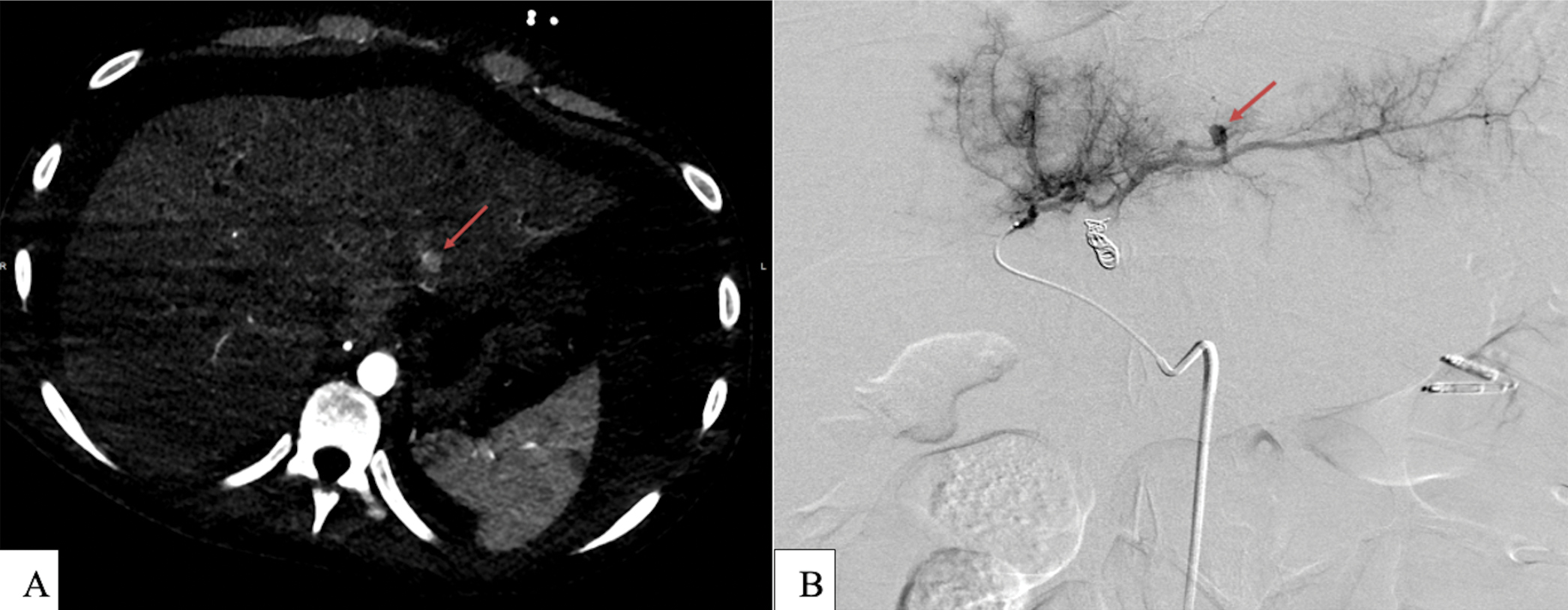 (a) Abdominal CTA revealing a small focus of contrast enhancement off from LHA branch (red arrow). (b) Selective LHA angiography showing 7 mm pseudoaneurysm off segment II LHA (red arrow).