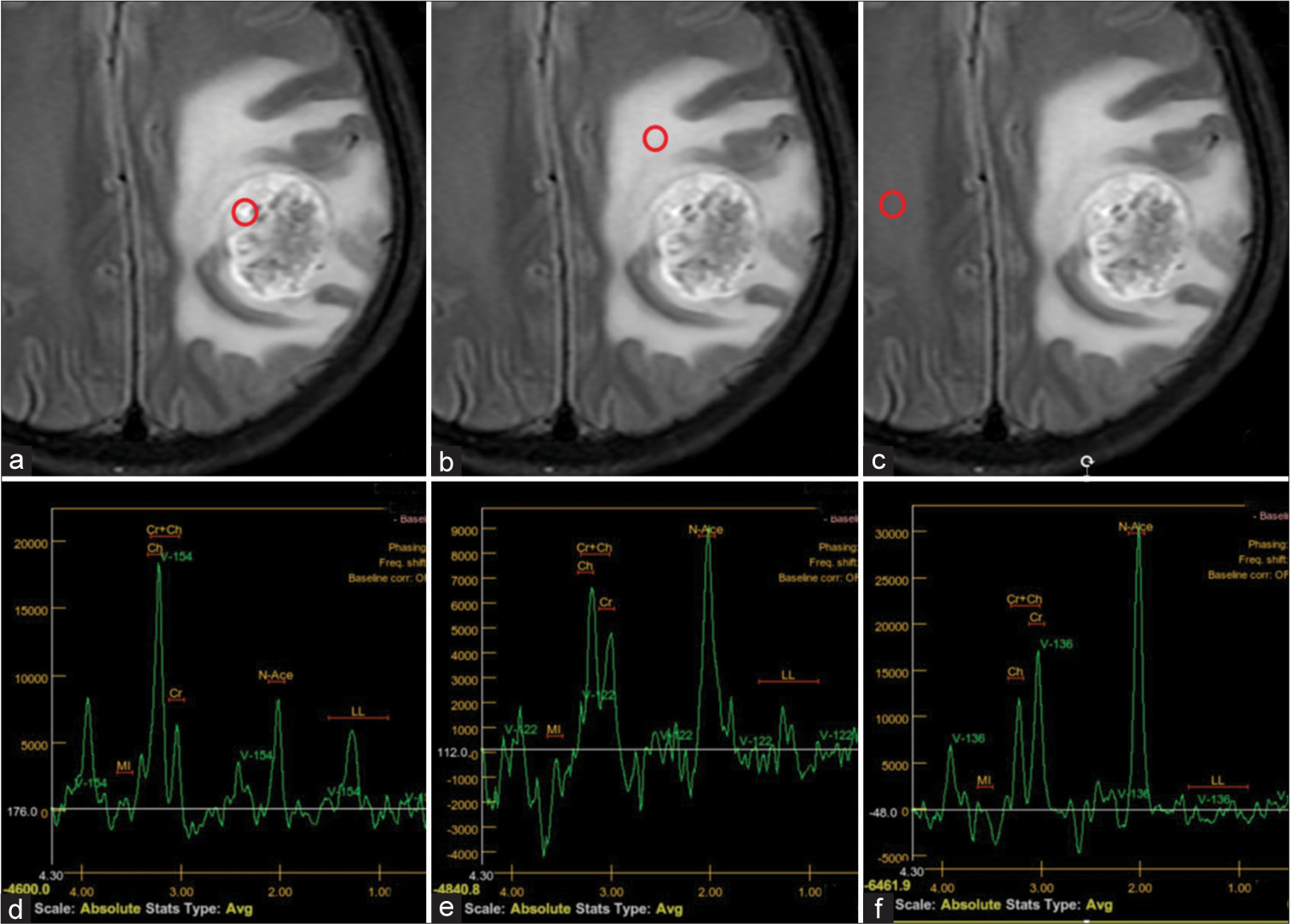 Left frontal-parietal glioblastoma in a 58-year-old female patient. (a-c) Positions of three regions of interest in the solid tumor component, peritumoral region, and contralateral benign white matter (indicated by red circles). (d-f) Magnetic resonance (MR) spectroscopy in the respective regions. (d) MR spectroscopic data of the solid tumor component reveals choline (Cho) elevation, N-acetylaspartate (NAA) reduction, and an elevated Cho/creatine ratio suggesting a tumor lesion. (e) MR spectroscopy of the peritumoral region shows increasing Cho and an increased Cho/NAA ratio in keeping with tumor infiltration. (f) Normal MR spectroscopy of contralateral benign white matter.