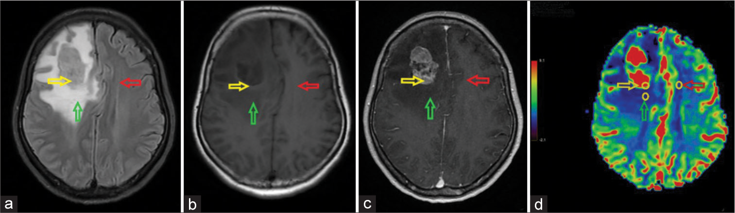 A right frontal solitary brain metastasis originating from lung cancer in a 50-year-old female patient. The positions of three regions of interest (yellow circles) in the solid tumor component (yellow arrow), peritumoral region (green arrow), and contralateral benign white matter (red arrow). (a) Fluid-attenuated inversion recovery image; (b) Non-enhanced axial T1-weighted image; (c) Contrast-enhanced axial T1-weighted image; and (d) Cerebral blood volume (CBV) map. The tumor is hypointense on T1W with moderate surrounding edema on axial fluid-attenuated inversion recovery, causing a mass effect that compresses the midline to the left, and heterogeneous enhancement. The CBV map shows hyperperfusion of the tumor compared to the surrounding brain tissue.