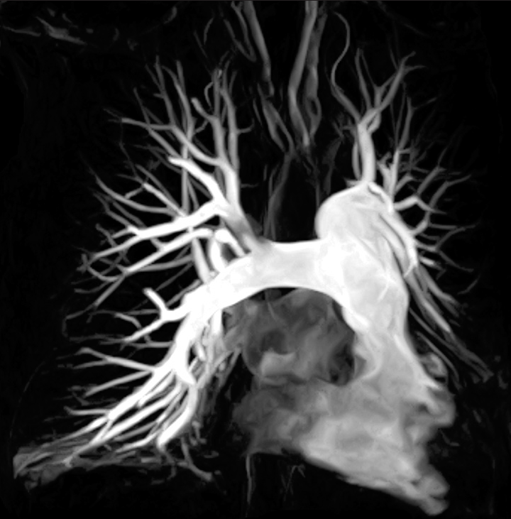 A 53-year-old woman who presented with dyspnea. (a) Coronal post-contrast magnetic resonance angiography multiple intensity projection depicting good opacification of the pulmonary arterial branches to the subsegmental level.