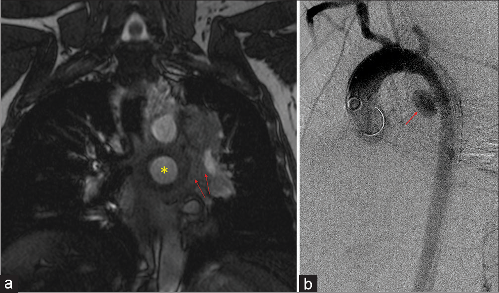 A 47-year-old male who presented with chest pain. (a) Coronal post-contrast magnetic resonance angiography sequence showing a large saccular aneurysm arising from the proximal descending aorta (yellow star) with periaortic hematoma (red arrows). (b) Sagittal aortogram confirming large saccular mycotic aneurysm (red arrow).