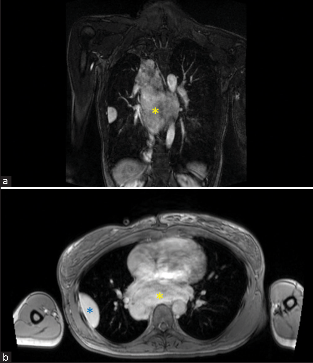 A 65 years old who presented with chest pain and dyspnea. (a) Coronal T1 post-contrast magnetic resonance angiography sequences showing a large posterior mediastinal mass (yellow asterisk). (b) Axial T1 post-contrast image confirming the large posterior mediastinal mass (yellow asterisk) and a pleural-based mass (blue asterisk).