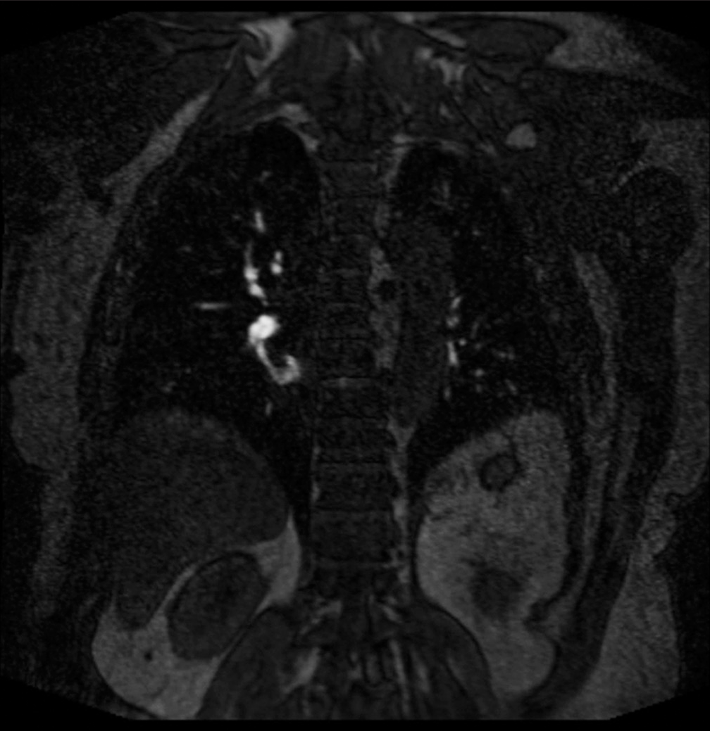 A 69 year old who presented with chest pain and dyspnea. (a) Pulmonary embolus. (b) Coronal (TWIST) post-contrast T1 magnetic resonance angiography sequence showing a non-occlusive scant filling defect in the right lower lobe (red arrow). TWIST: Time-resolved angiography with stochastic trajectories.