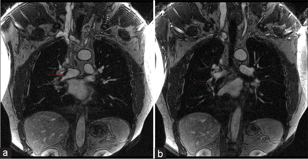 A 60 years old who presented with chest pain and dyspnea. (a) Pulmonary embolus. (b) Coronal (TWIST) post-contrast T1 magnetic resonance angiography sequence showing a non-occlusive scant filling defect in the right lower lobe (red arrow). TWIST: Time-resolved angiography with stochastic trajectories.