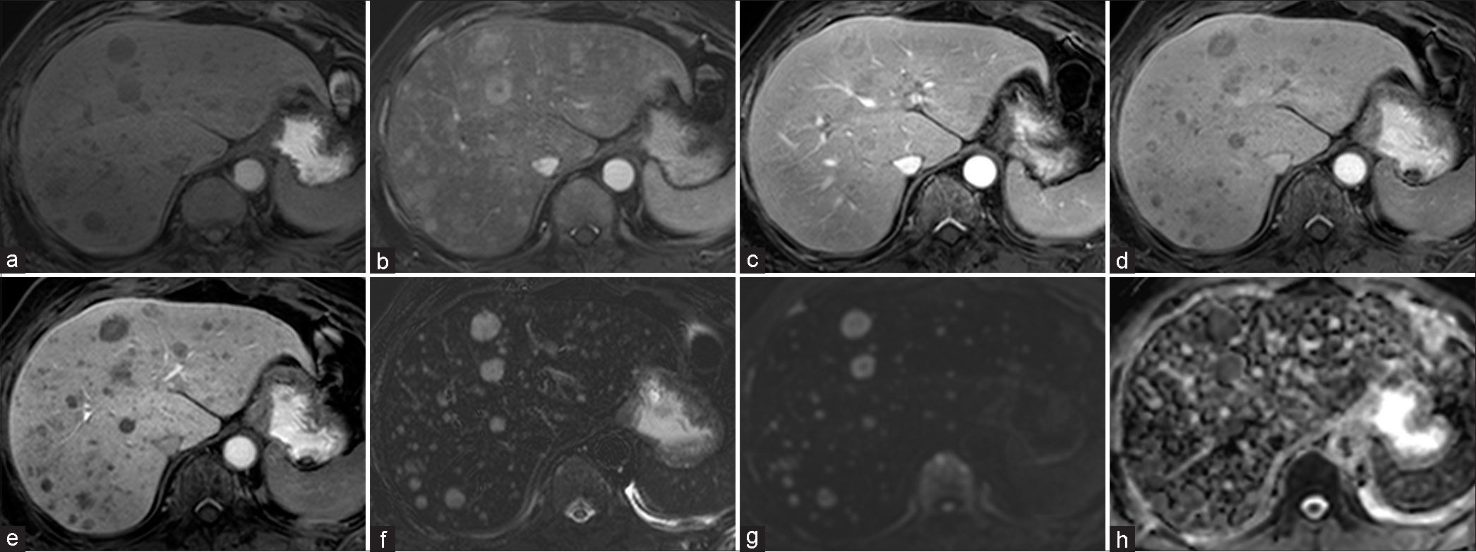 A 62-year-old woman with incidentally detected multiple hepatic lesions. (a) On the axial fat-suppressed T1-weighted magnetic resonance (MR) images, the innumerable well-defined nodular lesions showed hypointensity relative to the background liver tissue. (b) Dynamic contrast-enhanced MR images, the hepatic lesions showed arterial enhancement (c-d) and had washout enhancement pattern in portal and delayed phase. (e) On the hepatobiliary phase, the hepatic lesions showed low signal intensity. (f) On the axial fat-suppressed T2-weighted MR images hepatic lesions showed hyperintensity. (g) Diffusion weighted image (DWI) at b-value of 800 s/mm2 reveal high signal intensity. (h) And an apparent diffusion coefficient (ADC) map reveal a low ADC value.