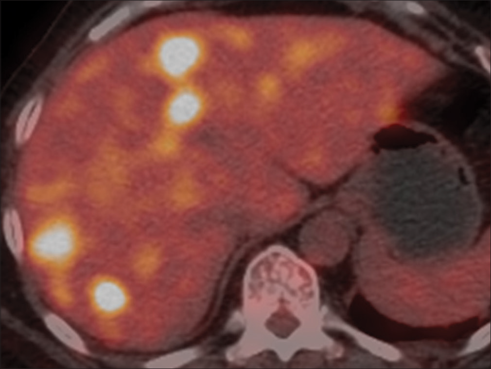 A 62-year-old woman with incidentally detected multiple hepatic lesions. Whole-body positron emission tomography-computed tomography revealed multiple hypermetabolic lesions (SUV max 8.8) in liver.