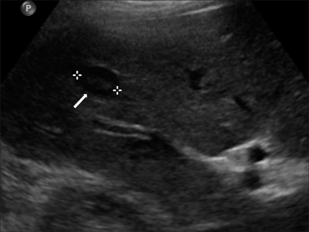A 62-year-old woman with incidentally detected multiple hepatic lesions. On the ultrasonography, the hepatic lesion (arrow and stars) was seen target appearance.