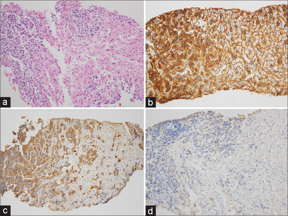 A 62-year-old woman with incidentally detected multiple hepatic lesions. (a) A core biopsy of hepatic nodule shows infiltration by atypical plasmacytoid cells (Hematoxylin-Eosin stain) (b) and immunohistochemical staining for CD138 confirms plasma cell infiltration. (c) Plasma cells demonstrate kappa light chain restriction by immunohistochemistry for immunoglobulin kappa (d) and lambda light chains.