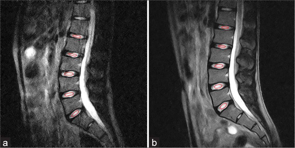 Example of ROIs (red circle) on T2 weighted images with TE of 30 ms in (a) upright position and (b) supine position. (ROI: Region of interest, T2: Transverse relaxation time, TE: Echo time).