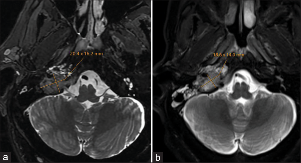 (a) Pre-treatment and (b) post-treatment imaging of the lesion, both on axial fat-saturated T2-weighted magnetic resonance imaging. The post-treatment study was performed shortly after completion of radiation therapy and demonstrates cessation of growth, with stable to minimally decreased size of tumor in maximal transaxial dimension (yellow lines).