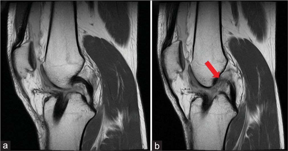 A 30-year-old female, years after prior ACL surgery presenting with acute knee pain, effusion, and mechanical instability after participating in a recreational basketball game. (a) A sagittal T1-weighted image demonstrating the torn anterior portion of autograft displaced anteriorly, which can become symptomatic with the knee in extension. (b) A sagittal T1-weighted magnetic resonance image of the torn anterior hamstrings autograft with the contused posterior portion in continuity and normal orientation (red arrow). (ACL: Anterior cruciate ligament.)