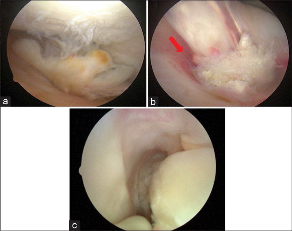 (a) Arthroscopic image of the extended right knee. The distal stump of the ruptured graft can displace anteriorly, causing a mechanical block to extension. (b) Arthroscopic image of flexed right knee. The ruptured autograft stump is shown debrided with residual hematoma of intact graft posteriorly (red arrow). The thin epiligamentous synovial tissue surrounding the graft suggests a later stage of ligament maturation or “ligamentization.” (c) Arthroscopic image of a right knee. The bare intercondylar wall of the lateral femoral condyle is not typically visualized arthroscopically unless a tear of the ACL is present. A complete femoral-sided tear of the ACL or mid-substance tear with resorption of the proximal end can give the “empty wall” appearance. The ACL is at the bottom right of the image, lying more horizontal than its native position. (ACL: Anterior cruciate ligament.)