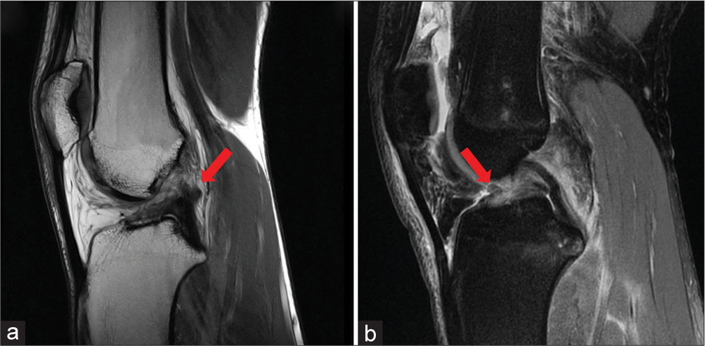 A 27-year-old female presents with sudden knee pain, audible pop, and immediate swelling following a jump during a volleyball game. (a) A sagittal T1-weighted magnetic resonance (MR) image. Note the difference in orientation of Blumensaat’s line and the torn ACL. (red arrow) (b) A sagittal fat-suppressed proton density MR image demonstrates of loss of continuity of ACL fibers and a dense increase in signal intensity at the intercondylar notch representative of hematoma (red arrow).(ACL: Anterior cruciate ligament).