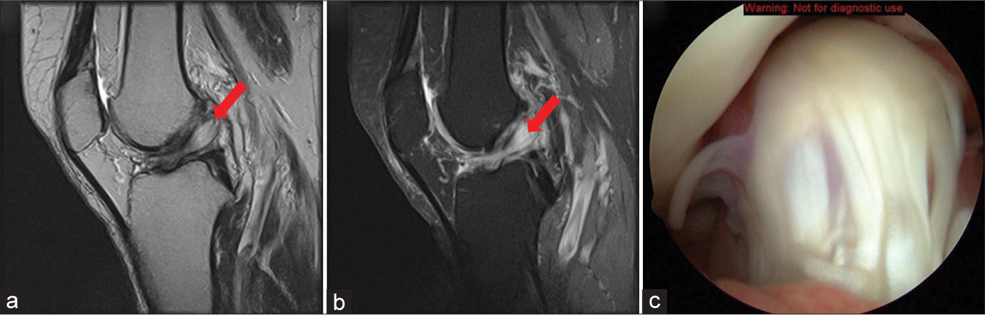 34-year-old female avid runner presents with intermittent knee pain and a sensation of fullness in the anterolateral aspect of her knee, especially during flexion. She denies any acute trauma but recalls increasing her training intensity in the past 6 months. On examination, there is mild joint effusion without significant ligamentous instability. (a and b) T1- and T2-weighted sagittal magnetic resonance images of the right knee displaying hypointense and hyperintense, respectively, oval-shaped masses within the ACL, as described in several case reports of ACL ganglion cysts (red arrow). (c) Arthroscopic image of ganglion cystic formation of the ACL with fiber-like projections draped over the ACL. (ACL: Anterior cruciate ligament).