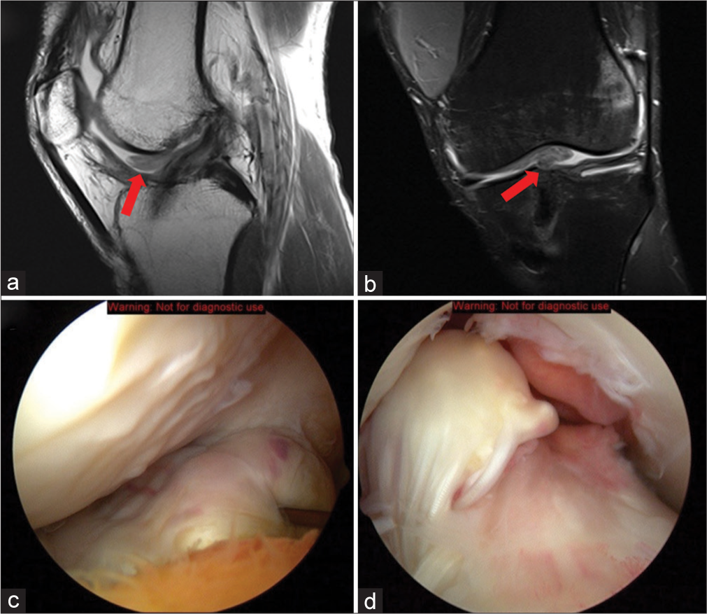 A 28-year-old male soccer player, 6 months post-operative from an ACL reconstruction using a patellar tendon graft, presents with progressive knee stiffness and a catching sensation during extension. He mentions that his post-operative rehabilitation was initially going well, but he has recently faced difficulty in fully extending the knee. On clinical examination, a restriction in terminal knee extension is noted. (a) T1-weighted sagittal image of the knee shows the intermediate signal intensity nodule of the intercondylar notch anterior to the ACL (red arrow). (b) A proton density-weighted coronal image of the knee demonstrates the same low-intermediate signal intensity nodule and its proximity to the tibial tunnel (red arrow). (c) Arthroscopic image of an extended right knee shows the “cyclops lesion” initially described by Jackson and Schaefer. The probe is firmly pressed into the nodule and demonstrates its fibrous consistency. This nodule was dubbed the “cyclops lesion” due to its head-like appearance and its characteristic focal reddish-blue areas of discoloration due to venous channels, which resemble an eye at arthroscopy. (d) Arthroscopic image of the right knee. The ganglion fiber-like projections are moved to the side to reveal the ACL tibial insertion. (ACL: Anterior cruciate ligament).