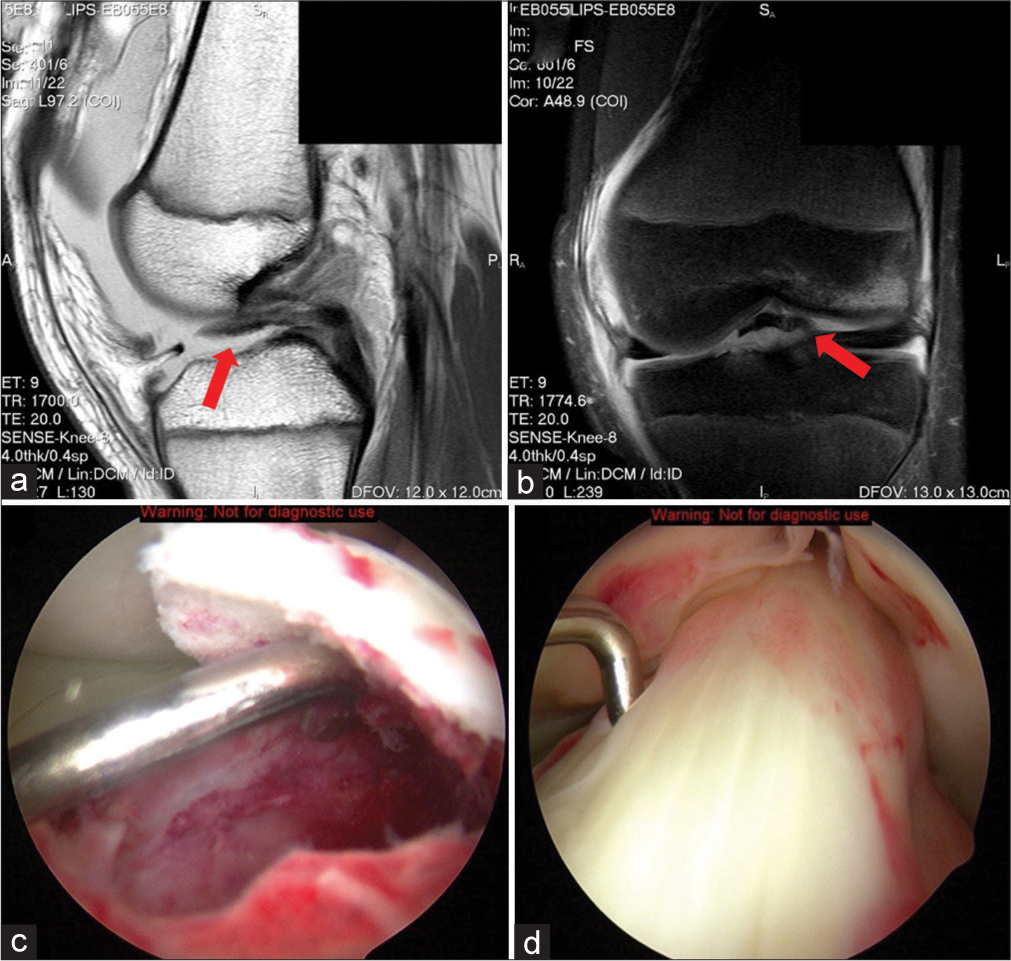A 14-year-old male football player presents after a sudden pivot and deceleration during a match. He recalls a “pop” sound and immediate pain in his left knee, preventing him from continuing to play. On examination, there is significant swelling and tenderness over the anterior aspect of the knee. (a) T1-weighted sagittal magnetic resonance imaging (MRI) of the left knee demonstrating an avulsed osteochondral fragment completely displaced and void of any bony contact (red arrow). Note the proximity of the intermeniscal ligament to the fragment and the fracture bed. This structure, as well as, the anterior horns of medial and lateral menisci can become entrapped in the fracture requiring arthroscopic versus open reduction. The anterior horn of the medial meniscus is involved most commonly. (b) Proton density-weighted fat suppressed coronal MRI of the left knee demonstrates another view of the Meyers and McKeever type III intercondylar eminence fracture (red arrow). The weight-bearing portion of the lateral femoral condyle has increased signal intensity indicative of the bone edema from the acute pivot shift mechanism of injury. (c) Arthroscopic image of the left knee. The fractured tibial intercondylar eminence is elevated by the probe exposing the fracture bed. Repair techniques rely on bone-to-bone healing of the osteochondral fragment to the underlying fracture bed resulting in superior results. (d) Arthroscopic image of the tibial eminence fracture reduced with the intact ACL attached to the fragment. (ACL: Anterior cruciate ligament).