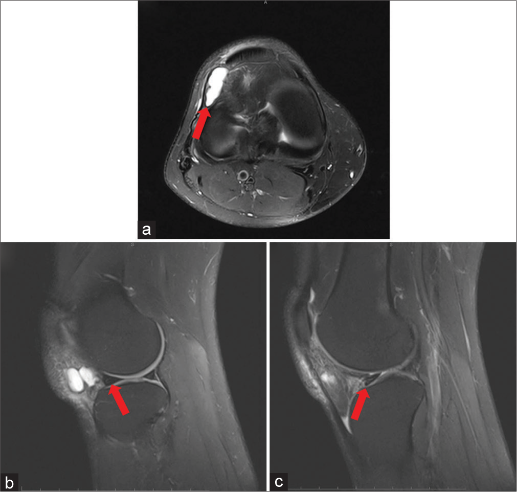 A 34-year-old female presented with a 6-month history of intermittent lateral knee pain. She denied any prior trauma but mentioned increased discomfort when climbing stairs. On physical examination, a palpable fullness was felt anteriorly at the lateral joint line, without signs of joint effusion. There was tenderness over the area with passive range of motion. (a) T2-weighted axial magnetic resonance (MR) image of a right knee demonstrates the anterior position of the signal-intense, lobular cyst and its relationship to the lateral meniscus and the infrapatellar fat pad (red arrow). (b and c) T2-weighted sagittal MR images of a right knee show the tear in the lateral meniscus and the communication of the joint fluid into the cyst (red arrow).