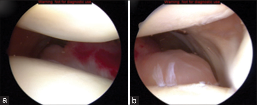 (a and b) Arthroscopic images of a large anterior lateral parameniscal cyst (the view is from superior portal looking through patellofemoral joint). The thin-walled, cystic appearance of the fluid-filled mass can be appreciated.