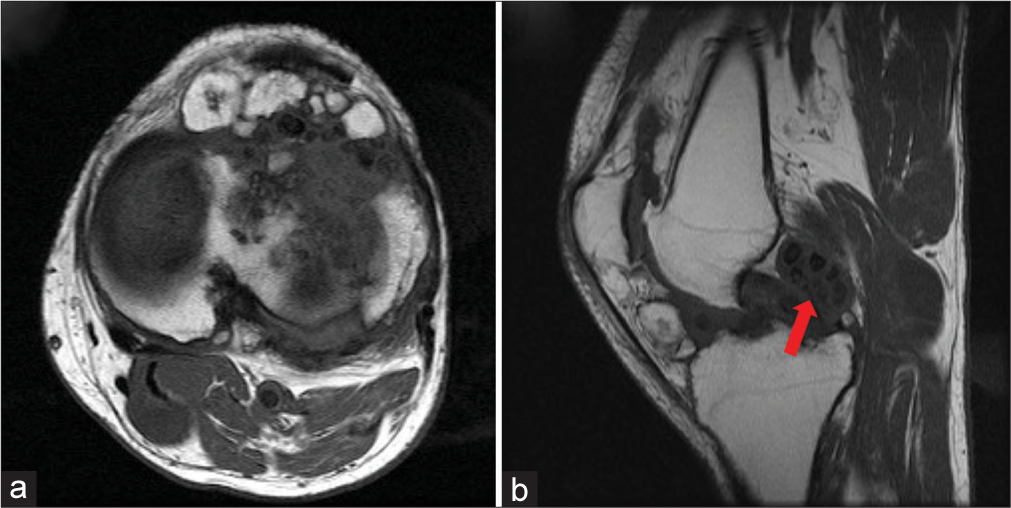 A 42-year-old female presented with intermittent pain and swelling in her left knee over the past 2 years. She described episodes where the knee would “lock” momentarily during movement. The pain was non-radiating and occasionally associated with a clicking sensation. No prior trauma or relevant family history was reported. Physical examination revealed a mildly swollen left knee with palpable loose bodies, tenderness along the joint line, and a limited range of motion due to pain during flexion and extension. (a and b) T1-weighted axial and sagittal magnetic resonance images demonstrate multiple cartilaginous lesions with variable appearance, indicating the degree of mineralization. The most common pattern reveals low to intermediate signal intensity with T1-weighting and very high signal intensity with T2-weighting with hypointense calcifications (red arrow).