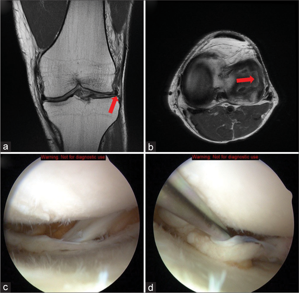 A 38-year-old male athlete presents to the clinic with a complaint of sudden onset of sharp pain in his right knee. He describes the pain as localized to the outer aspect of the knee and exacerbated by twisting motions or full knee flexion. The patient recalls a similar episode 1 year ago, for which he underwent arthroscopic lateral meniscus repair. On examination, the lateral joint line was tender to palpation. The McMurray test was positive, eliciting pain and a click during the maneuver. The swelling was noted around the joint, but no ligamentous laxity was observed. The patient described difficulty in fully extending his knee without discomfort. (a and b) T1-weighted coronal and axial magnetic resonance images of a left knee demonstrate a previously partially resected unstable lateral meniscus with a sharp right angle of the anterior one- third. Notice the contour changes drastically as the inner margin is followed on the axial image (red arrow). This finding is indicative of a retear. The extrusion of the thin-rimmed lateral meniscus on the coronal image demonstrates the instability of the reinjured post-operative lateral meniscus. (c and d). Arthroscopic images of a left knee. The thin-rimmed lateral meniscus is indicative of a previous partial meniscectomy. The popliteal tendon (asterisk) can be seen on its course through the popliteal hiatus. The probe is pulling the remaining lateral meniscus into the lateral compartment demonstrating the instability of the damaged meniscus.