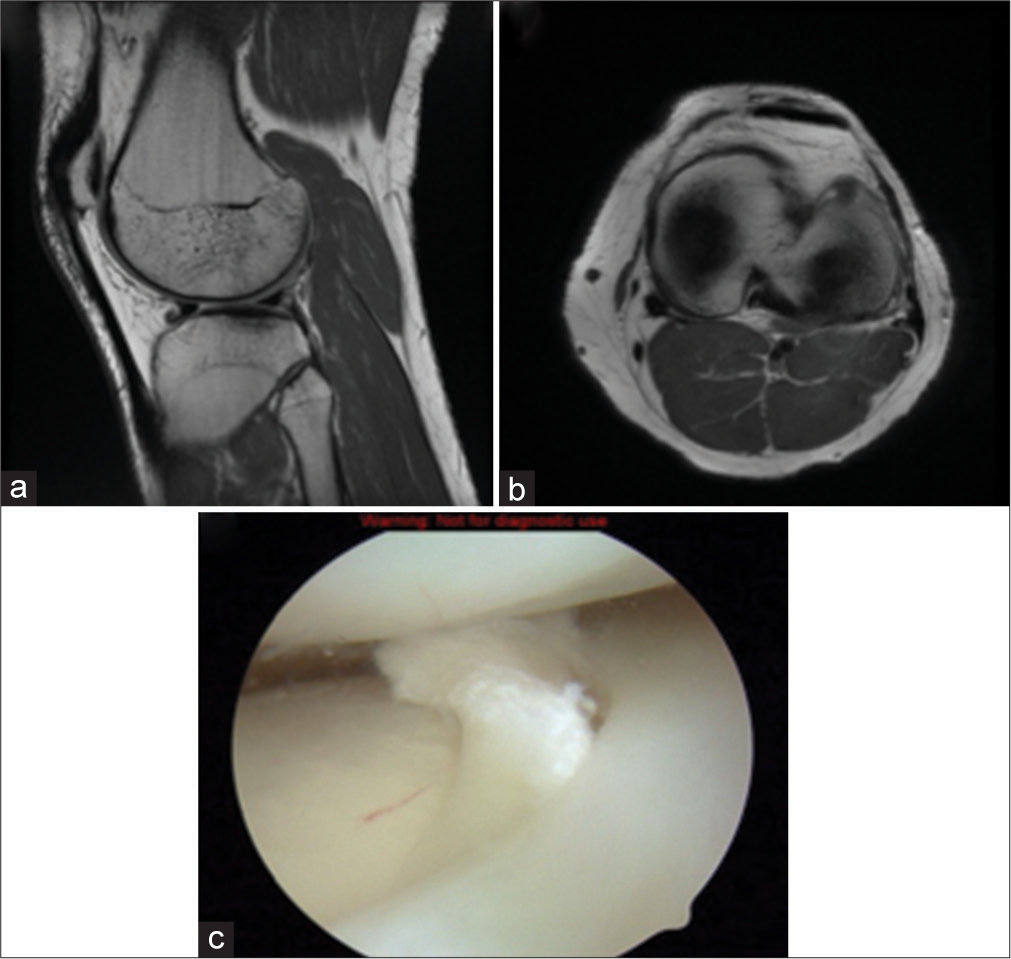 A 34-year-old female presented with recurrent episodes of locking and giving way of her left knee. She recounted a recent hiking trip where she stumbled on uneven terrain, after which she began to experience intermittent sharp pains in the lateral aspect of her knee. Physical examination revealed joint line tenderness on the lateral side, and her range of motion was limited due to pain during terminal extension. (a and b): T1-weighted sagittal and axial magnetic resonance images of a left knee demonstrating flap tear of anterior 1/3 body of lateral meniscus displaced anteriorly. When evaluating the sagittal cross-section of the meniscus, the difference of the triangular shape between the anterior and posterior meniscus can be appreciated, as well as the displaced fragment anteriorly (red arrow). (c) The correlating arthroscopic image demonstrates the torn fragment from the undersurface of the lateral meniscus flipped into the lateral compartment. One can appreciate the relationship of the displaced fragment in between the lateral femoral condyle and lateral tibial plateau, and the potential to become symptomatic.