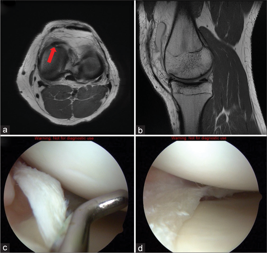 A 21-year-old male presented with complained of persistent medial knee pain and occasional clicking sounds in his right knee, exacerbated when arising from a seated position. He recalled a twisting injury to the knee while playing football 2 months prior. Physical examination revealed pronounced joint line tenderness medially and a positive McMurray test. (a and b) T1-weighted axial and sagittal magnetic resonance images of the left knee demonstrating a large flap tear of the medial meniscus displaced into the joint space (red arrow). The change in contour and thickness from the anterior one-third to the mid-body of the medial meniscus on the axial cut indicates the presence of a tear. The detached fragment folds in the joint towards the intercondylar notch when following its path. (c) Arthroscopic image of the correlating left knee demonstrates the large flap tear floating in the knee. (d) After debridement of the unstable, free-floating flap tear fragment, the extent of delamination of the superior portion of the medial meniscus can be appreciated.