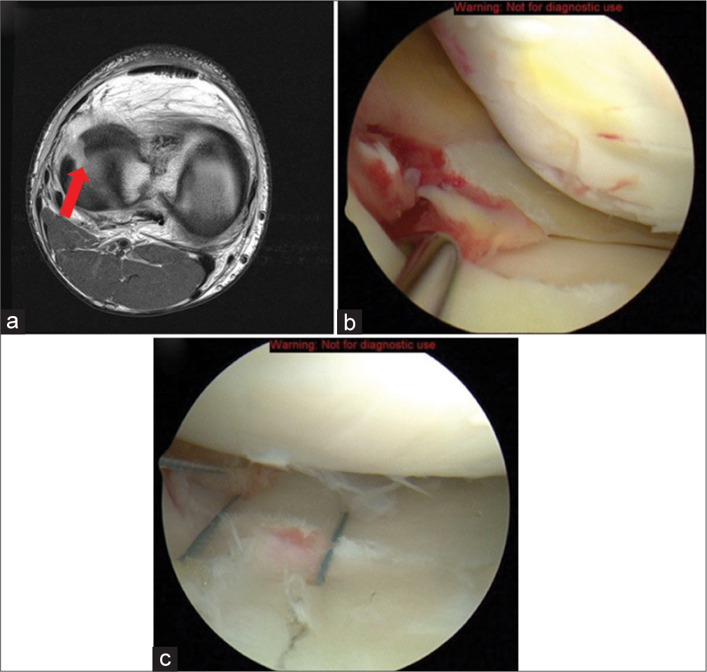 A 22-year-old male football player presented with acute-onset lateral knee pain, following a sudden pivot on his left leg during practice. He described the pain as sharp, localized to the lateral aspect of the knee. There was no history of previous knee injuries. On examination, there was notable tenderness along the lateral joint line without significant effusion. (a) T1-weighted axial magnetic resonance image of the right knee demonstrates a large mid-body radial tear of the lateral meniscus (red arrow). The tear is complete extending from the inner margin to the periphery. There is a concomitant ACL tear, as well (not shown). (b and c) The correlating arthroscopic images of the right knee detail the extension of the tear into the red-red zone of the meniscus and the capsulomeniscal junction. The bleeding ends of the torn lateral meniscus are appreciated in (b). An excellent all-inside suture repair is achieved in (c). This technique has been shown to be promising and an effective alternative to partial meniscectomy. (ACL: Anterior cruciate ligament).
