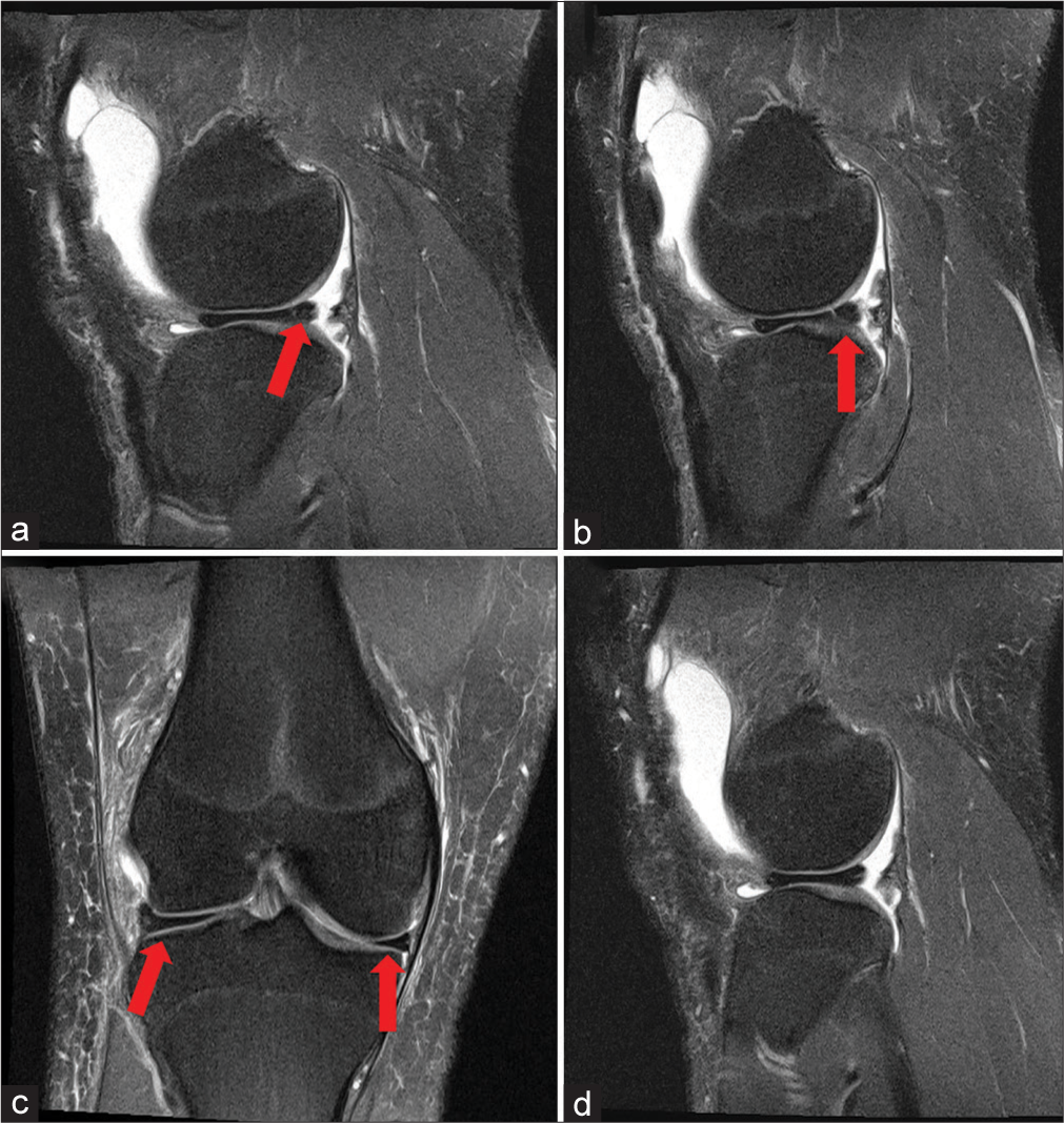 A 26-year-old male basketball player presented with recurrent episodes of locking and discomfort in his right knee, especially when performing squatting motions. He mentioned a history of similar episodes in the past, but they usually resolved with rest. However, the current episode has persisted longer. Physical examination revealed tenderness over the lateral joint line and a positive McMurray’s test (left to right). (a, b) Two consecutive T2-weighted sagittal images of a right knee demonstrate a thick mid-body of the lateral meniscus with a small, symptomatic radial tear posteriorly (red arrows). (c) A stark comparison in size is made between the discoid lateral meniscus and the smaller medial meniscus in the bottom left coronal image (red arrows). Extension of the lateral meniscus over the majority of the lateral tibial plateau can be appreciated in the coronal view. Image (d) is another consecutive T2-weighted sagittal image of a right knee demonstrating a thick mid-body of the lateral meniscus with a small, symptomatic radial tear posteriorly.