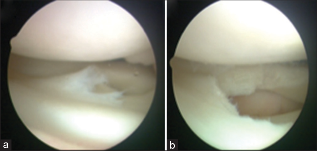 (a) An arthroscopic image of the lateral discoid meniscus “draping” over the lateral tibial plateau. (b) Images demonstrating the saucercized lateral meniscus. The increased thickness of the residual meniscus is evident.