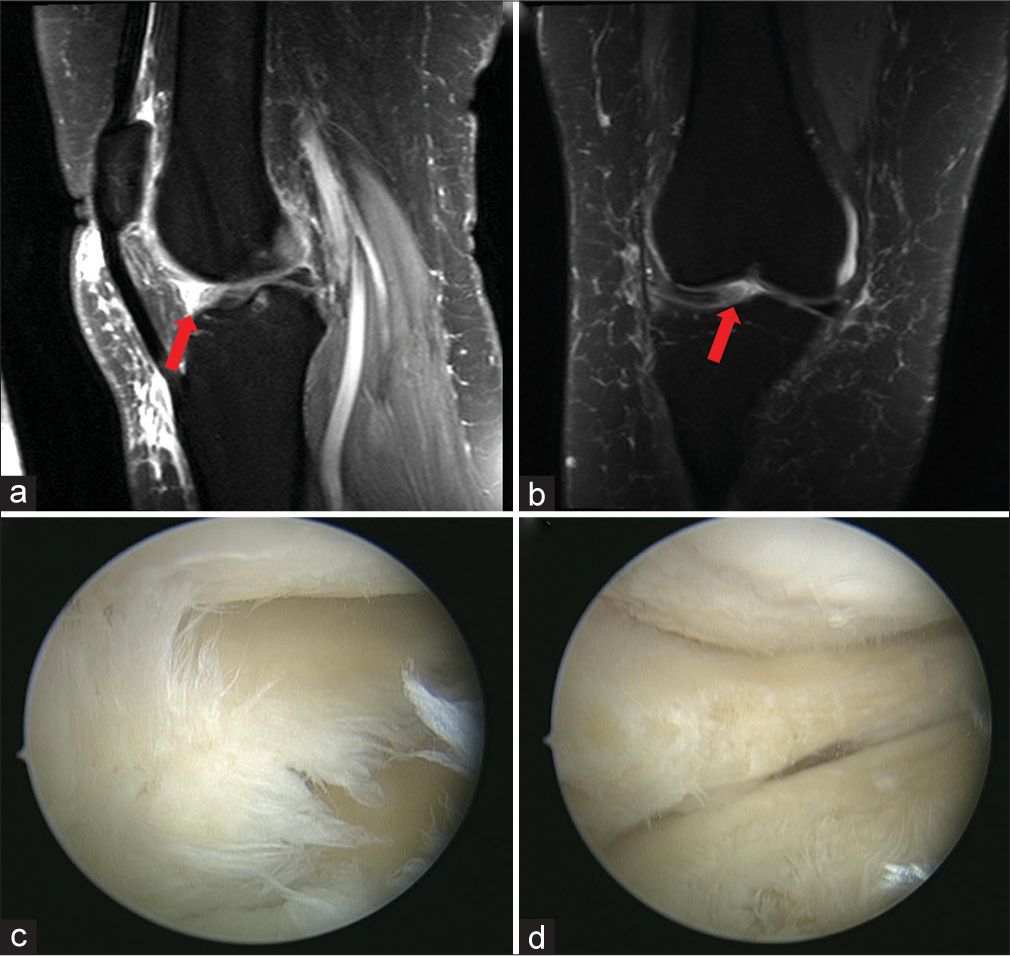 A 58-year-old female office worker complained of persistent pain in her left knee, particularly noticeable when ascending stairs or after prolonged sitting. She described the pain as a dull ache, which occasionally felt sharp with certain movements. She denied any history of trauma but noted the discomfort gradually increased over the past year. On examination, there was mild swelling of the knee joint, tenderness over the lateral joint line, and limited range of motion due to pain. (a and b) Coronal and sagittal T2-weighted images demonstrate increased signal intensity of the lateral meniscus anterior horn suggestive of a frayed, degenerative tear (red arrow). (c) Correlating arthroscopic image shows the frayed and degenerative appearance of the anterior horn lateral meniscus in a right knee. (d) The debrided anterior horn lateral meniscus.