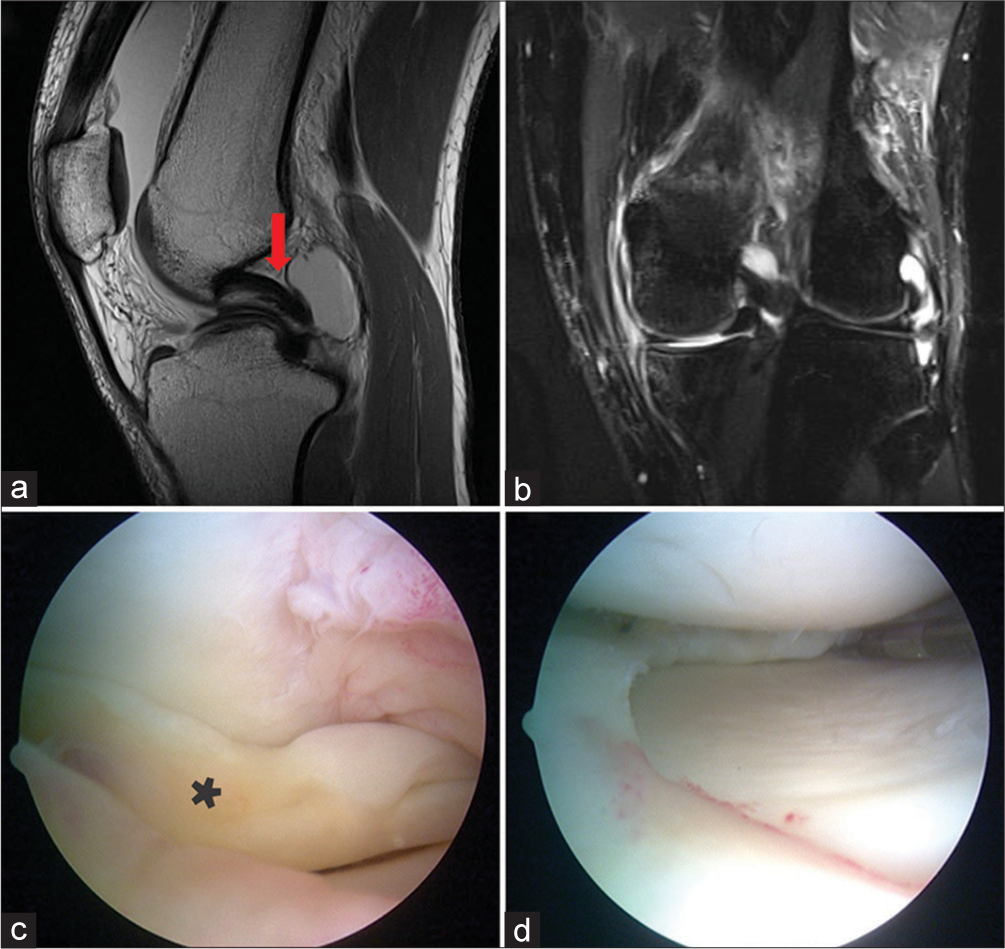 A 35-year-old female presented to the clinic after experiencing a sudden, sharp pain in her left knee when she was descending a flight of stairs at her home. She recalled missing a step, which caused her knee to twist awkwardly. Immediately after the incident, she observed swelling in the knee and had difficulty fully extending the leg. (a and b) Sagittal T1 and coronal T2-weighted magnetic resonance imaging images demonstrate the classic medial meniscus bucket handle tear patterns. The “Double PCL sign” (red arrow) is evident in (a) (red arrow) with residual attachment of the torn fragment to the posterior horn. (b) The bucket handle portion of the medial meniscus folded underneath the medial femoral condyle. The coronal image also shows the thin medial meniscal rim which further confirms the presence of a tear. (c and d) Arthroscopic images of the medial compartment. In (c), the medial meniscus (asterisk) is folded underneath the medial femoral condyle above. The tear is debrided away leaving behind a stable medial meniscus in (d). (PCL: Posterior cruciate ligament.)