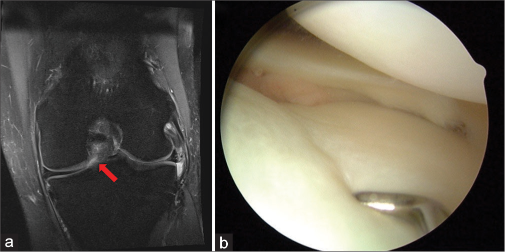 A 28-year-old male runner, presented with a persistent dull ache in his right patella, particularly noticeable after long runs or descending stairs. There was no history of trauma or previous knee injuries. On examination, there was tenderness on the patellar facets with mild effusion but no ligamentous instability. Crepitus was noted during knee flexion and extension. (a) Coronal T2-weighted image a left knee demonstrates focal area of increased thickness and decreased signal intensity of the articular cartilage overlying the lateral tibial plateau representative of chondromalacia (red arrow). (b) Arthroscopic image of the lateral compartment of a left knee. Examination of the tibial articular surface of the lateral compartment finds soft and swollen articular cartilage. This is indicated by the metal probe sinking into the abnormally soft tissue.