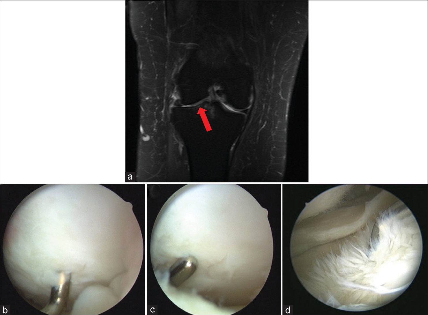 A 42-year-old female presented complaining of recurrent episodes of sharp pain in her left knee, exacerbated by prolonged walking or standing. She also reported occasional catching sensations but denied any locking or giving way. The pain had been progressively worsening over the past year. She recalled a minor twisting injury to the knee about 18 months ago, but there was no significant swelling or bruising at the time. (a) Coronal T2-weighted image of a right knee demonstrates grade II and III chondral lesions of the femoral and tibial surfaces of the lateral compartment (red arrow). (b and c) demonstrate a grade II chondral lesion of the lateral femoral condyle. (d) A significantly fibrillated grade III chondral lesion of the tibial surface.