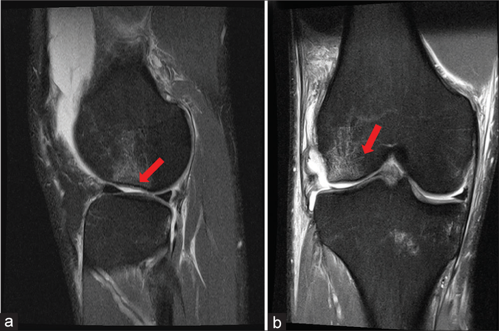 A 38-year-old female dance instructor presented to the orthopedic clinic with a 3-week history of acute-onset right knee pain. She described a specific event during a dance routine where she landed awkwardly on her extended leg, causing immediate pain on the lateral aspect of her right knee, without any associated swelling or locking. The pain was localized to the lateral aspect of his right knee. (a and b) T2-weighted sagittal and coronal of a right knee. The increased signal intensity of the lateral femoral condyle subchondral bone is characteristic of the bone bruising associated with a pivot shift injury (red arrows). This should help focus attention on the contour of the articular cartilage and subchondral layer. There is a slight depression or loss of the normal round contour of the lateral femoral condyle. This should be noted along with other structures damaged in the pivot shift injury mechanism.