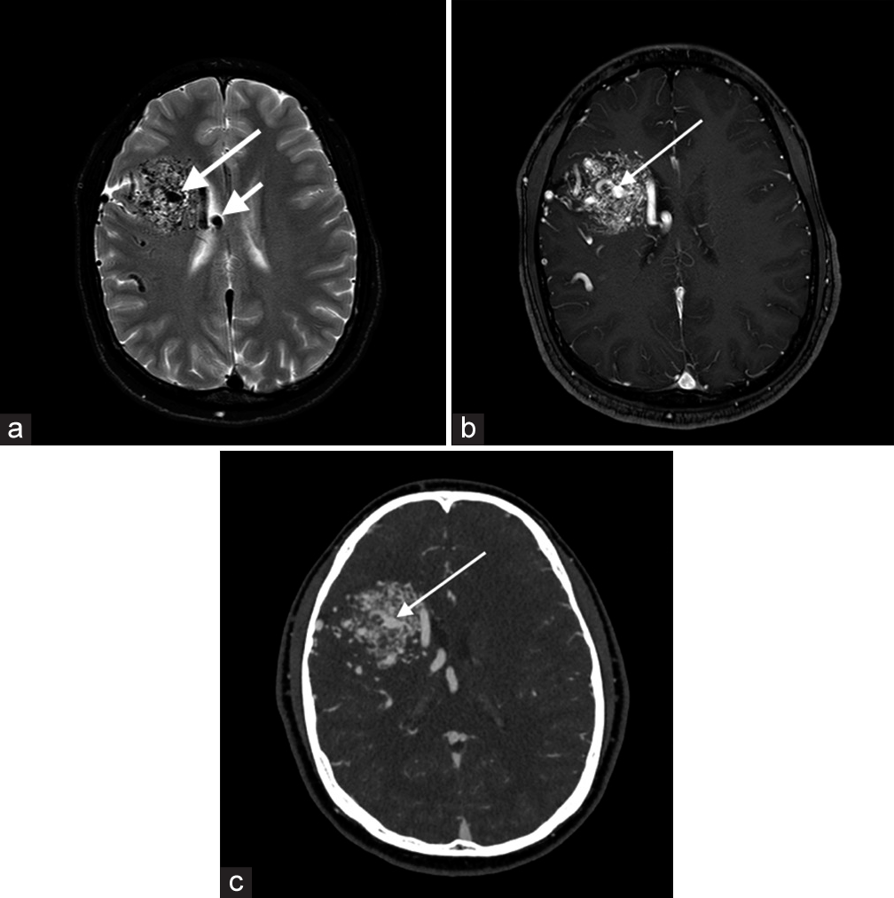 A 20-year-old male with the right frontal arteriovenous malformation (AVM). (a) Axial T2-weighted image shows a T2 heterogeneous signal nidus (long white arrow) in the right frontal lobe with dilated adjacent T2 hypointense vessels (short white arrow). (b) Axial T1+C image demonstrates a heterogeneously enhancing lesion (long white arrow) with adjacent dilated vessels. (c) Computed tomography angiogram confirms a right frontal AVM nidus (long white arrow) with a centrally draining vein medially.