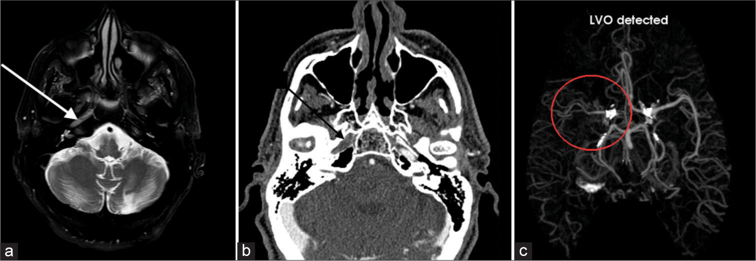 A 64-year-old male with the right internal carotid artery (ICA) occlusion. (a) Axial T2-weighted image shows absence of flow void (white arrow) in the petrous segment of the right ICA which is worrisome for arterial occlusion. (b) Computed tomography angiogram confirms lack of contrast related enhancement in the right petrous ICA (black arrow) consistent with occlusion. (c) Furthermore, AI detection platform detects this large vessel occlusion as well (red circle). LVO: Large vessel occlusion, AI: Artificial intelligence.