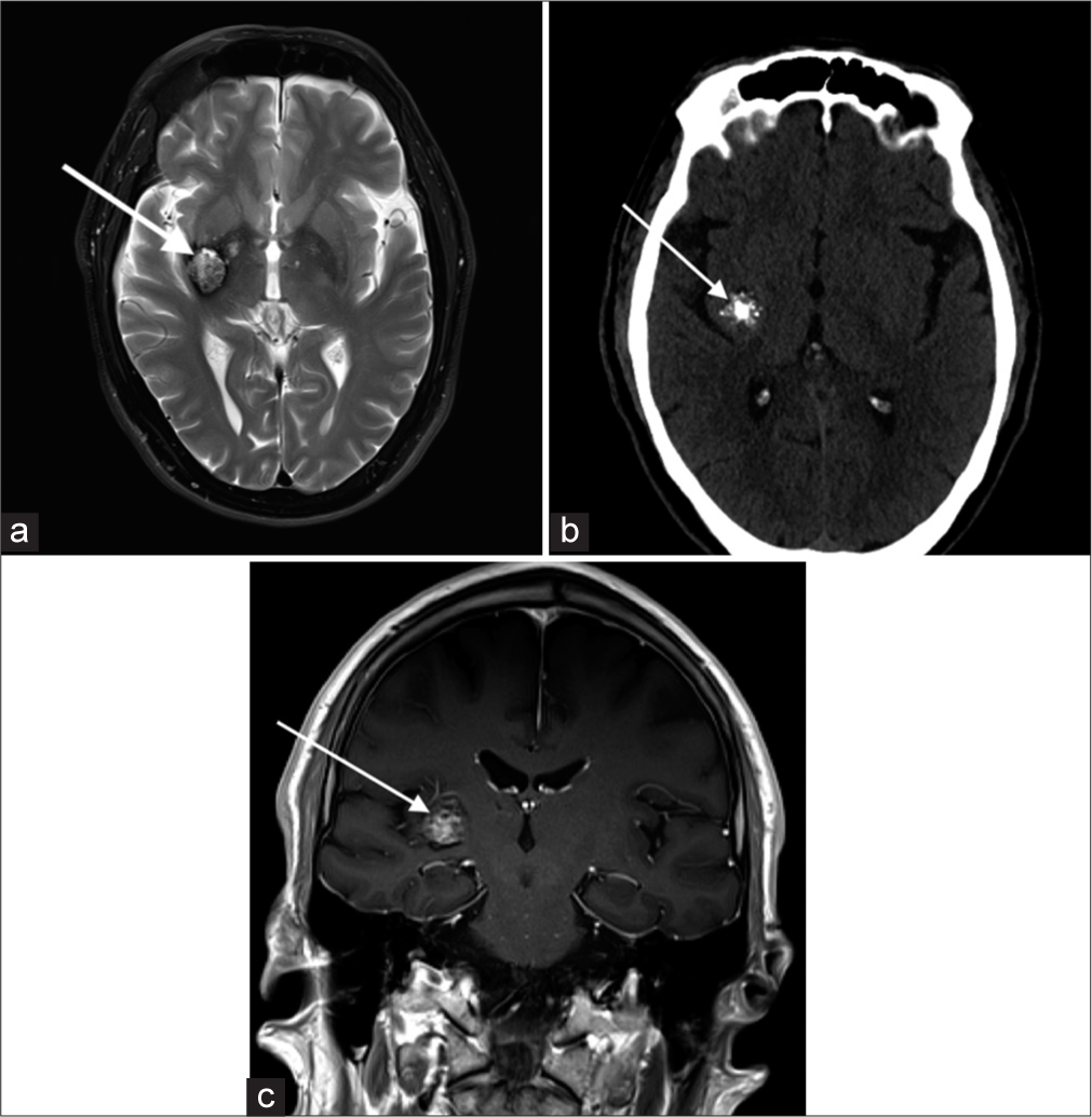 A 67-year-old male with the right basal ganglia cavernous malformation. (a) Axial T2-weighted image shows a popcorn shaped lesion (white arrow) in the right posterior putamen and globus pallidum with a peripheral hypointense rim. (b) Non-contrast head computed tomography demonstrates internal calcifications (white arrow). (c) Lesion shows internal heterogeneous enhancement (white arrow) on the coronal T1+C image. Combination of these imaging findings is consistent with a cavernous malformation.
