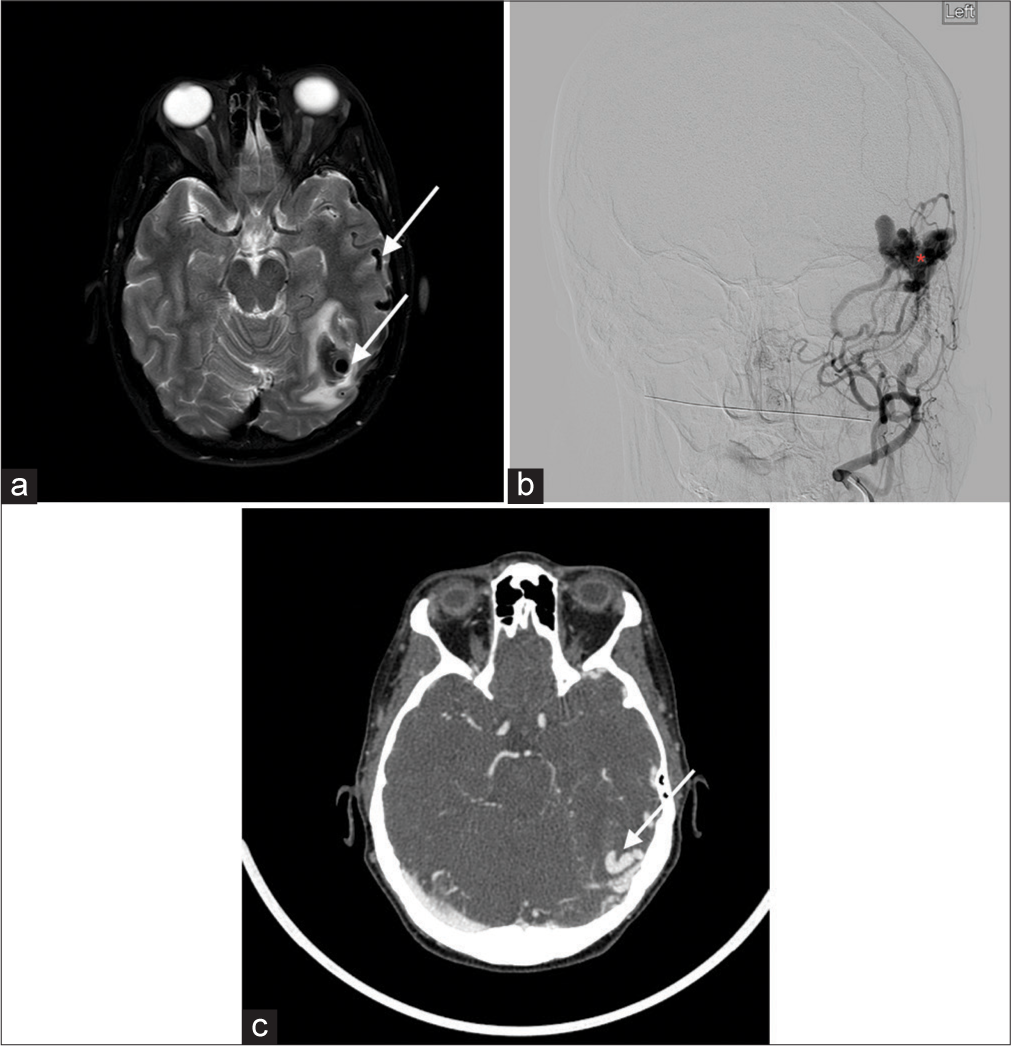 A 52-year-old female with the left temporal dural arteriovenous fistula (dAVF). (a) Axial T2-weighted image shows a T2 hypointense lesion (long white arrow) in the posterior left temporal lobe with adjacent dilated cortical veins (short white arrow) and surrounding edema, worrisome for an underlying vascular lesion. (b) Conventional catheter angiogram confirms Borden 3 left tentorial dAVF (red asterisk) with multiple arterial pedicles arising from the left external carotid artery (left Medial Meningeal Artery (MMA), left occipital/posterior auricular arteries). (c) Axial computed tomography angiogram image again demonstrates these findings (white arrow). MMM: Medial meningeal artery.