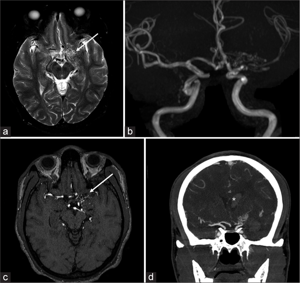 A 29-year-old female with Moyamoya. (a) Axial T2-weighted image show a cluster of vessels in the expected location of the proximal M1 segment of the left middle cerebral artery (MCA), (white arrow), and poor visualization of the carotid terminus, raising concern for underlying Moyomoya. (b) Time-of-flight magnetic resonance angiogram (MRA) confirms multiple small collateral vessels in this region. (c) 3D-rendered MRA image further confirms these findings (white arrow), with also right carotid and MCAs shown for comparison. (d) These findings are also evident on coronal maximal intensity projection computed tomography angiogram image, which also demonstrate intraventricular hemorrhage (white asterisk), which is one of the complications of Moyamoya disease. R stands for right, L stands for left.