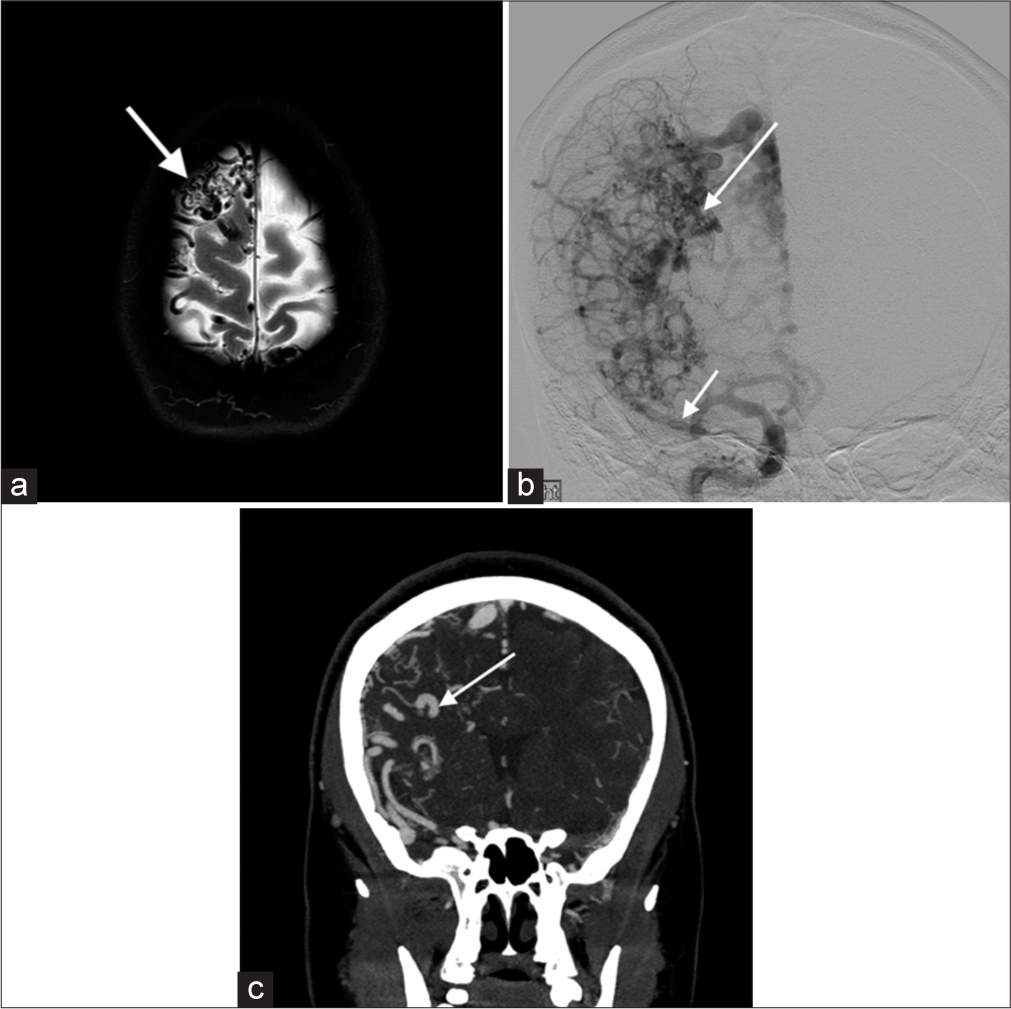 A 35-year-old female with proliferative angiopathy. (a) Axial T2-weighted image shows multiple dilated T2 hypointense vessels in and along the right frontal lobe, a nidus (white arrow) and normal adjacent brain parenchyma. Findings are suggestive of a proliferative angiopathy. (b) Conventional catheter angiogram shows a larger (>3 cm) nidus (long arrow) and multiple prominent arterial feeders (short white arrow). (c) Computed tomography angiogram demonstrates abnormal vessels originating from right anterior and middle cerebral arteries (white arrow). Findings are consistent with proliferative angiopathy.