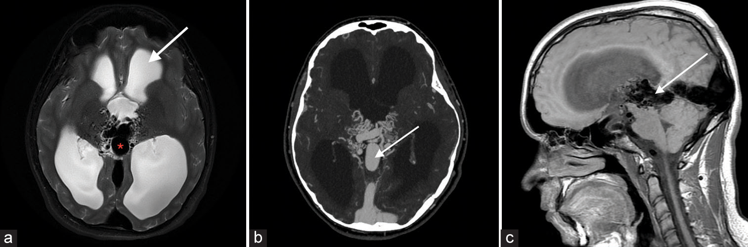 A 17-year-old male with vein of Galen malformation. (a) Axial T2-weighted image shows a tangled mass of abnormal connection of the arteries and the median prosencephalic vein of Markowski (white arrow). There is also associated moderate hydrocephalus (red asterisk). (b) Computed tomography angiogram demonstrates opacification of the abnormal vessels and medial prosencephalic vein (white arrow). (c) Sagittal T1-weighted image further confirms the findings (white arrow).